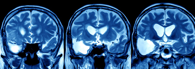 Photo of brain MRI scan. Focus On Traumatic Brain Injury banner image.
