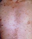 This patient with chickenpox developed lesions on the skin of his chest and torso.