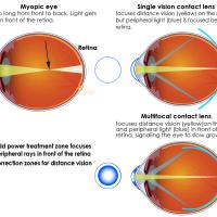 Multifocal contact lenses have two basic portions for focusing light. The center portion of the lens corrects nearsightedness so that distance vision is clear, and it focuses light directly on the retina. The outer portion of the lens adds focusing power to bring the peripheral light rays into focus in front of the retina. Animal studies show that bringing light to focus in front of the retina cues the eye to slow growth. 