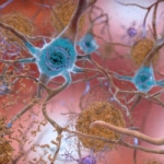 beta-amyloid plaques and tau in the brain 