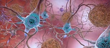 Brain cells with plaques and tangles typical in Alzheimer's disease