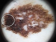Superficial spreading melanoma in situ on dermoscopy.jpg