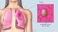 Mayo Clinic Q and A: Pinpointing a specific cause of lung cancer isn’t possible. Signs Of Lung Cancer, Lung Cancer Symptoms, High Antioxidant Foods, Brain Healthy Foods, Organic Meat, Naturopathy, Healing Food, Health Facts