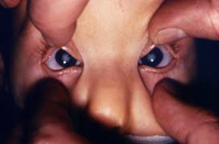 Infant with typical cloudiness of the eye lenses; that is, cataracts, in a case of CRS