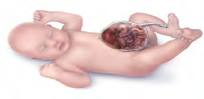 Illustration of baby with Omphalocele