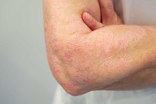 Psoriasis is a lifelong condition but effective treatments are available (Alamy/PA)