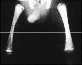 X-ray of bone abnormalities, syphilitic metaphysitis in an infant with diminished density in the ends of the shaft and destruction at the proximal end of the tibia 