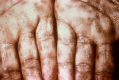 This photograph shows a close-up view of keratotic lesions on the palms of this patient’s hands due to a secondary syphilitic infection