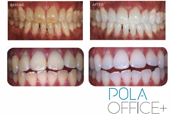 Pola In Office Teeth whitening