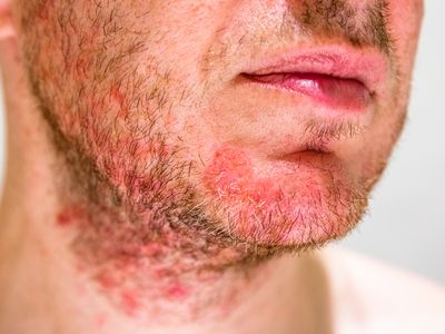 A person with seborrheic dermatitis in the beard area (eczema)