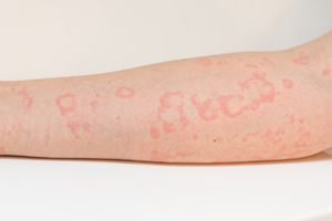 A person with hives on their skin