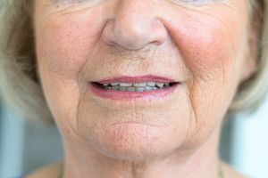 Older woman with facial flush