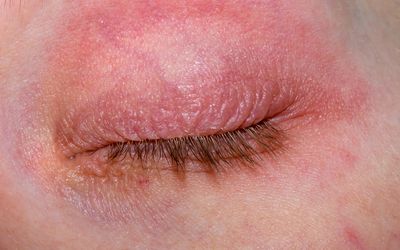 Dry skin of the eyelids, reddened, itchy, atopic blepharitis. Closed eye with contact allergy close up