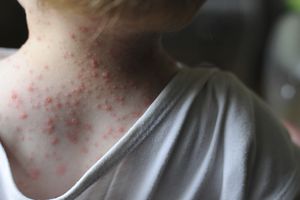 A child with chicken pox.