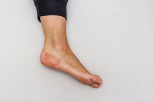 Dyshidrotic eczema on a heel of a foot