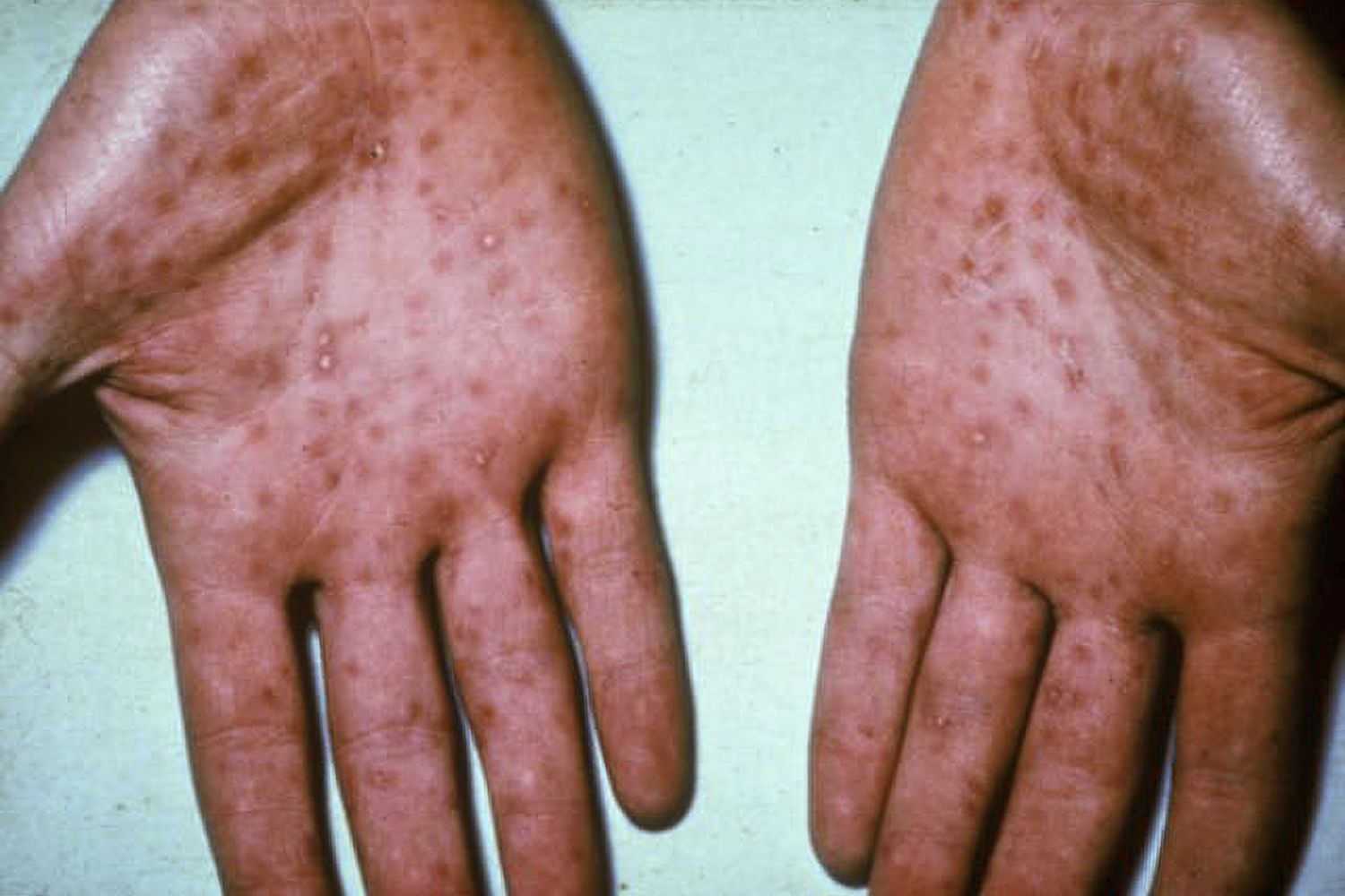 A syphillis rash on hands