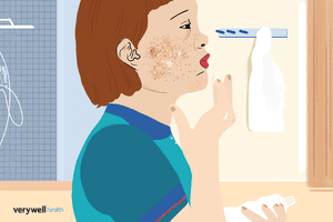 A person applying cream to red spots and blisters on their face.