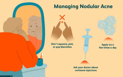 Managing nodular acne