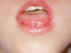 Child's mouth showing hand, foot and mouth disease