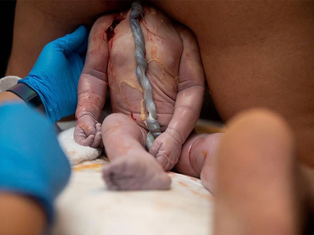 baby with umbilical cord getting delivered