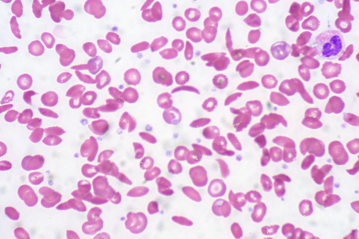 Sichelzellenanämie - Peripherer Blutausstrich