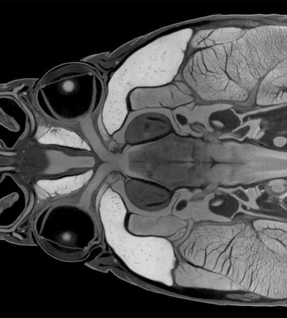 A black, white and grey image of a CT scan