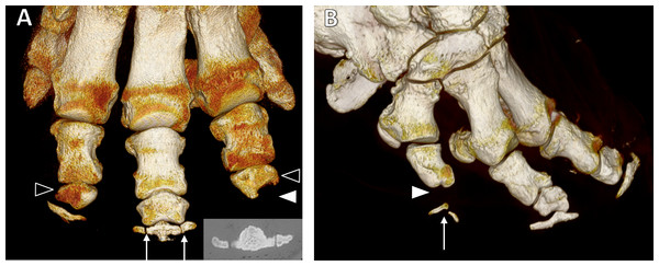 Three-dimensional reconstructions from CT scans.
