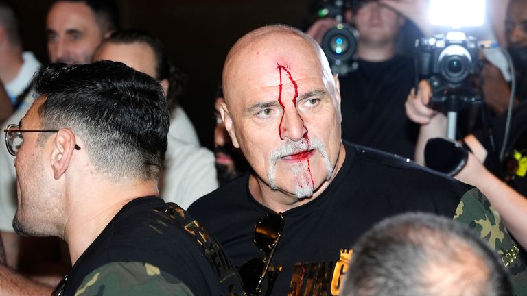John Fury with blood on his face during a media day. Pic: PA