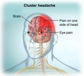 Migraine / Clusterhoofdpijn Chronisch
