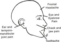 Triggers Points of the head that can be caused by the Morton's Toe, after Travell Jaw Pain