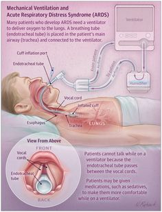 This JAMA Patient Page describes acute respiratory distress syndrome (ARDS) and its risk factors, treatment, and long-term effects. Acute Respiratory Distress Syndrome, Respiratory Distress Syndrome, Critical Care Nursing, Respiratory Therapy Student, Medical Surgical Nursing