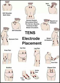 TENS Electrode Placement Exercises, Fitness, Workout, Ten, Exercise, Fitnes, Leger, Ibs