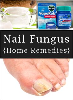 Nail Fungus: What It Is & How To Treat It  Pinned in the event this is something I need to know how to treat....vt Natural Home Remedies, Toe Nails, Nail Fungus, Tips, Natural Health, Health And Beauty, Health And Beauty Tips