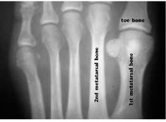 Short 1st metatarsal bone seen in Morton's Toe Foot Pain, Second Toe
