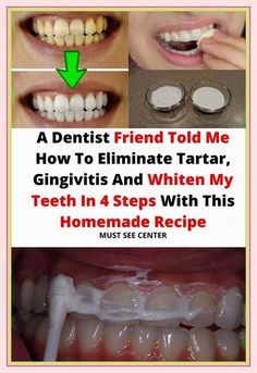 A Dentist Friend Told Me How To Eliminate Tartar, Gingivitis and Whiten My Teeth In 4 Steps With This Homemade Recipe Antiseptic Mouthwash, Dental Plaque, Cavities, Vitamins And Minerals