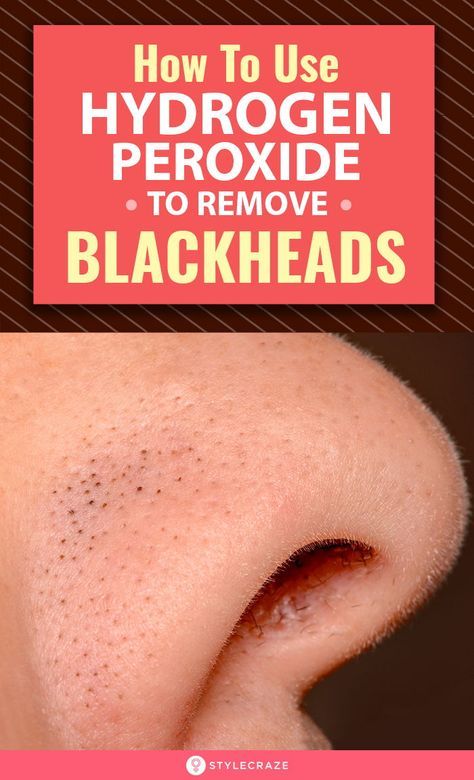 Get Rid Of Blackheads, Remove Blackheads From Nose, Blackhead Remover Diy, Blackhead Remover, Natural Remedies For Anxiety, Blackheads On Nose, Diy Blackhead Remover, Natural Cough Remedies, Brown Spots On Face