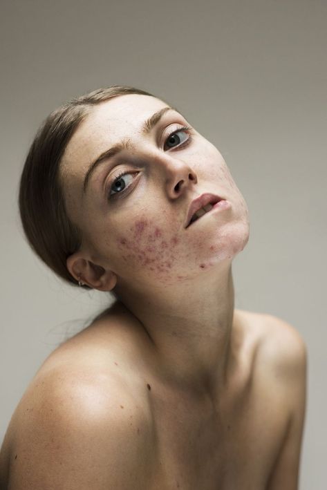 Photographs of bare-faced women with common skin conditions celebrate the beauty of imperfection https://www.creativeboom.com/inspiration/photographs-of-bare-faced-women-with-common-skin-conditions-celebrate-the-beauty-of-imperfection/ Normal Skin, Acne Pictures, Raw Beauty, Facial, Imperfection Photography, Severe Acne, Bare Face, Acne Scars, Skin Problems