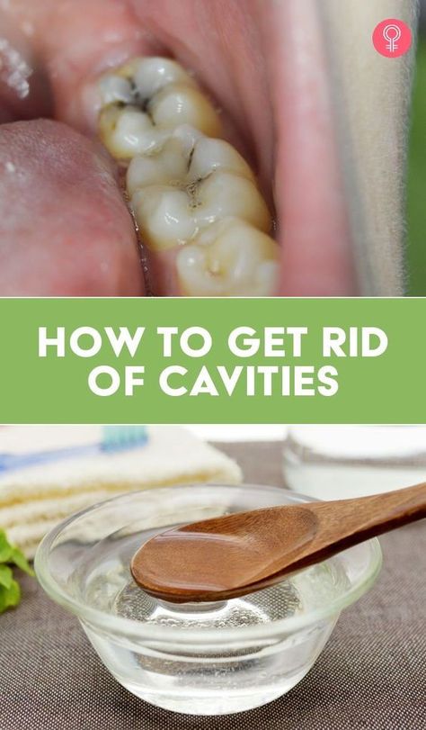 Fitness, How To Get Rid Of Plaque On Teeth, Getting Rid Of Cavities Naturally, How To Prevent Cavities, Natural Remedies For Cavities, Home Remedies For Cavities, Remedies For Tooth Ache, Remedies For Tooth Pain, Cure Tooth Ache