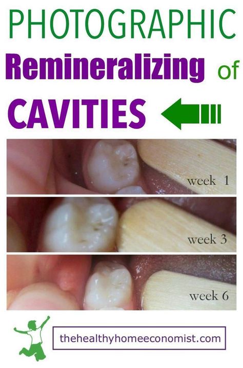 Do you have cavities but aren't able to go to the dentist? If so, you will want to see these photos from The Healthy Home Economist proving that you can fix it yourself! Read all about these hacks on how to heal your teeth from cavities. Fitness, Teething, Nutrition, Health, Oral Health, Oral Health Care, Tooth Decay, Cavities, Fix It