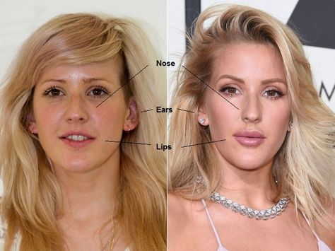 ellie-goulding-before-and-now-ellie-goulding-nose-job-ellie-goulding-breast-implants-ellie-goulding-lip-injections-ellie-goulding-plastic-surgery3 Lips, Ellie Goulding, Ellie Goulding Hair, Ellie, Wrinkle Care, Juvederm, Perfect Lips, Injections