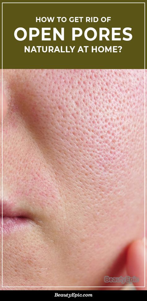 Get Rid Of Pores, Clogged Pores, How To Reduce Pores, How To Close Pores, Unclog Pores, How To Reduce Pimples, How To Open Pores, Shrink Pores, How To Clean Pores