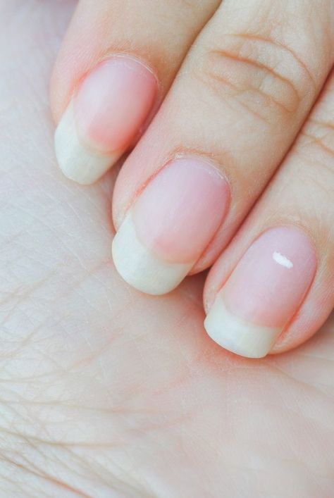 We asked experts what do white spots on nails mean, what causes white spots on nails, and how to get rid of white spots on nails. #realsimple#nailpolishideas#nailstrendingnow#trend#easynailpolishart#beautyhacks#beautydiy White Spots In Nails, White Spots On Nails, White Spots On Fingernails, White Spots Under Nails, Nail Bed Damage, Nail Problems, Nail Fungus, Nail Health, White Marks On Nails