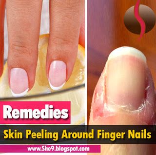 Skin Peeling around Finger Nails | Causes, Consequences and 10 Home Remedies - She9 | Change the Life Style Manicures, Dry Cuticles Treatment, Cuticle Repair, Peeling Cuticles, Cuticle Care, Cuticle Care Diy, Dry Cracked Skin, Dry Cuticles, Cracked Cuticles Remedies