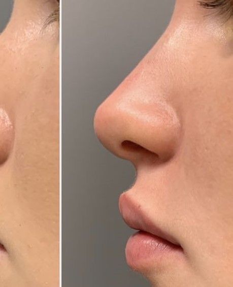 Nose Job Inspiration Asian, Fox Eye Before And After, Nose Job Natural, Rhinoplasty Front View, Nose Job Inspiration Natural, Perfect Nose Front View, Natural Nose Job, Nose Job Inspo, Nose Slimmer