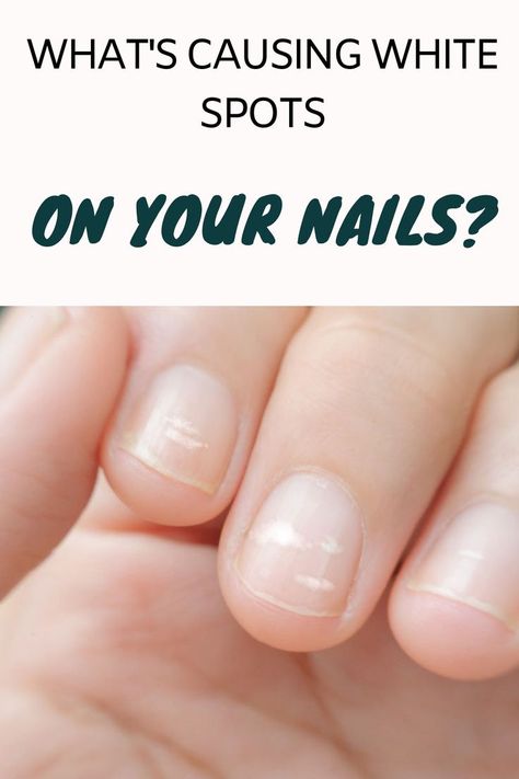 white spots on nails White Spots On Fingernails, White Spots On Toenails, White Spots On Nails, Fungal Nail Infection, Nail Infection, Ingrown Toe Nail, Nail Health, Fungal Nail, Nail Fungus