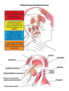 Fibromyalgia, Head Pressure Points, Nerve Pain, Spinal Tap Headache Relief, Types Of Headaches Chart, Tension Relief, Trigger Point Therapy, Types Of Headaches, Tension Headache
