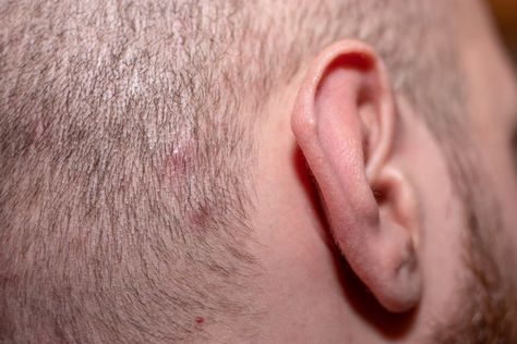 Why Are You Getting Pimples On Your Scalp - If you frequently have oily hair, an abundance of oil may be the root of your scalp.............. Prevent Ingrown Hairs, Treat Ingrown Hair, Ingrown Hair Removal, Ingrown Hair Bump, Scalp Problems, Ingrown Hair On Scalp, Severe Dandruff, Scalp Bumps, Ingrown Hairs