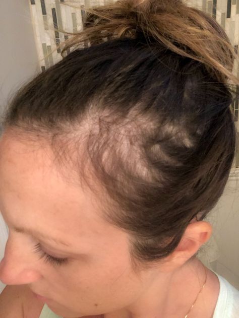 How to Quickly Cover Bald Spots During Postpartum Hair Loss - Just Simply Mom Hair Growth Tips, Urban, Inspiration, Hair Loss, Hair Loss Women, Why Hair Loss, Hair Regrowth, Regrow Hair, Postpartum Hair Loss
