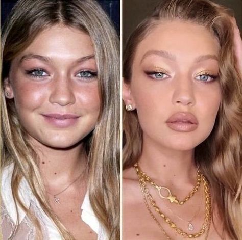 Instagram, Nose Job, Nose Surgery, Face And Body, Lip Fillers, Bare Face, Facial, Beauty Trends, Haar