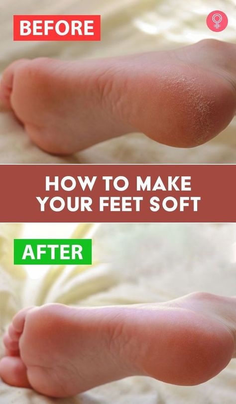Diy, Home Remedies, Home Remedies For Hemorrhoids, Dry Cracked Feet, Soften Heels, Dry Cracked Heels, Soften Feet Overnight, Dry Feet Remedies, Soften Feet